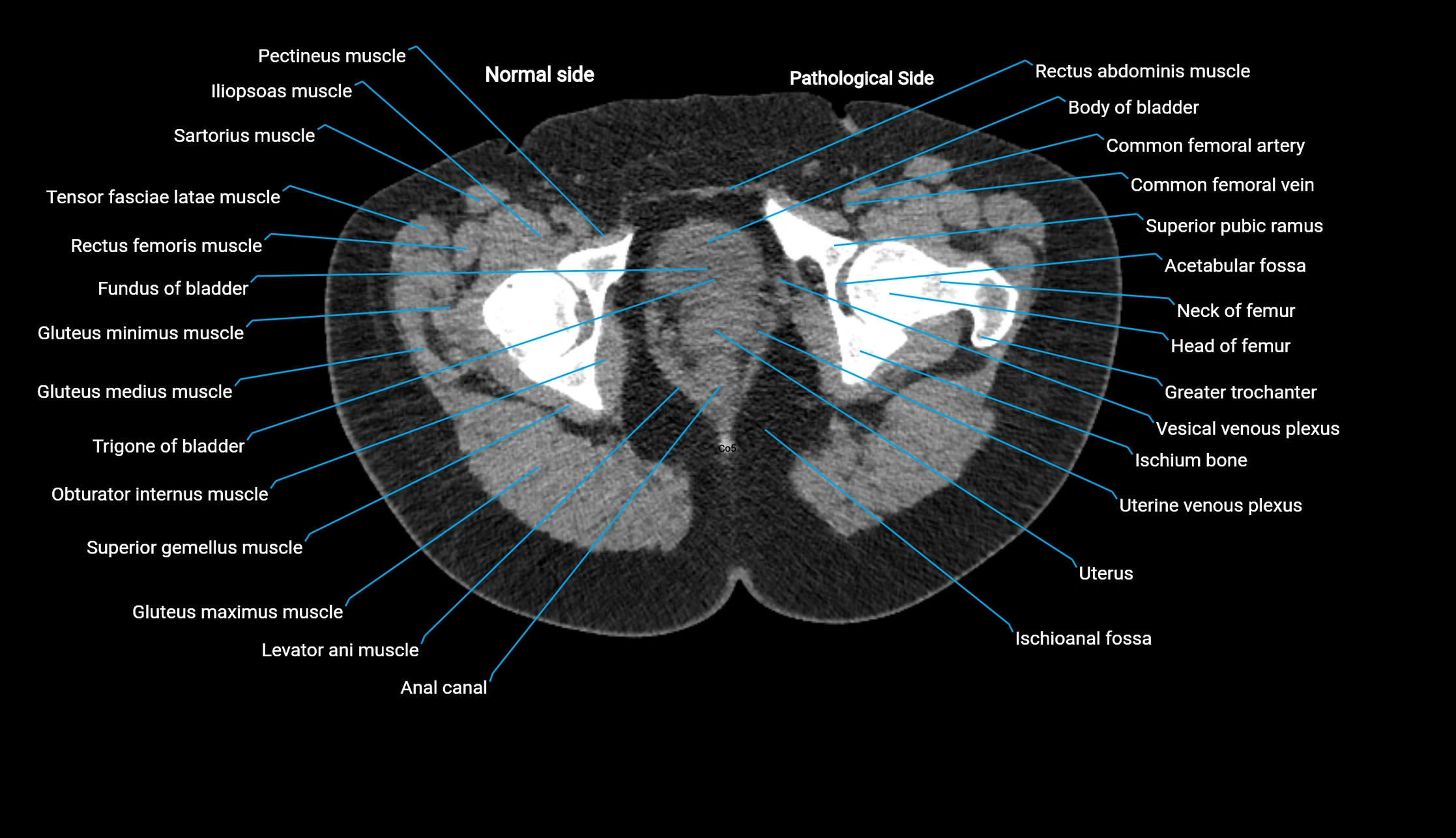 CT KUB axial cross sectional anatomy  radiology image -img-00201-00164.webp